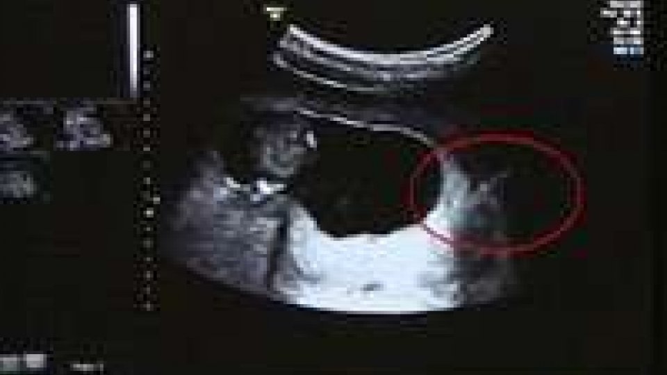 Svizzera, autorizzato test per individuare bambini Down in fase prenatale