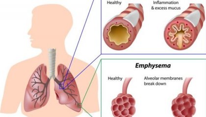 BPCO: cos'è e come prevenirla
